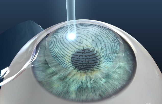 Cirurgia Refrativa a Laser com Tecnologia Wavefront
